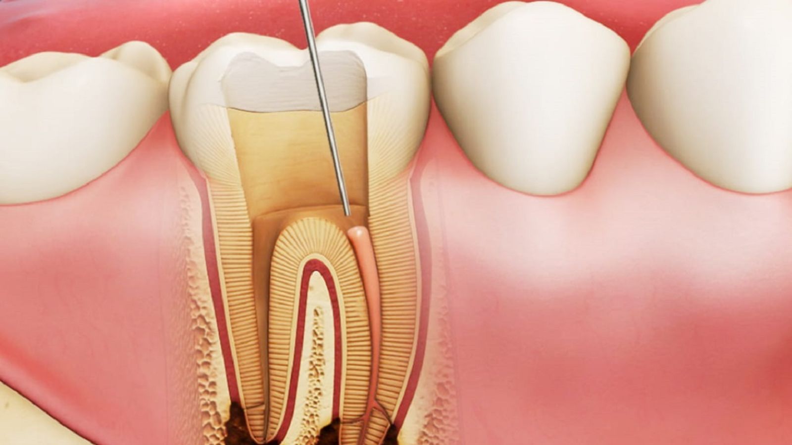 Viêm tủy gây ra cảm giác đau nhức và khó chịu cho bệnh nhân.