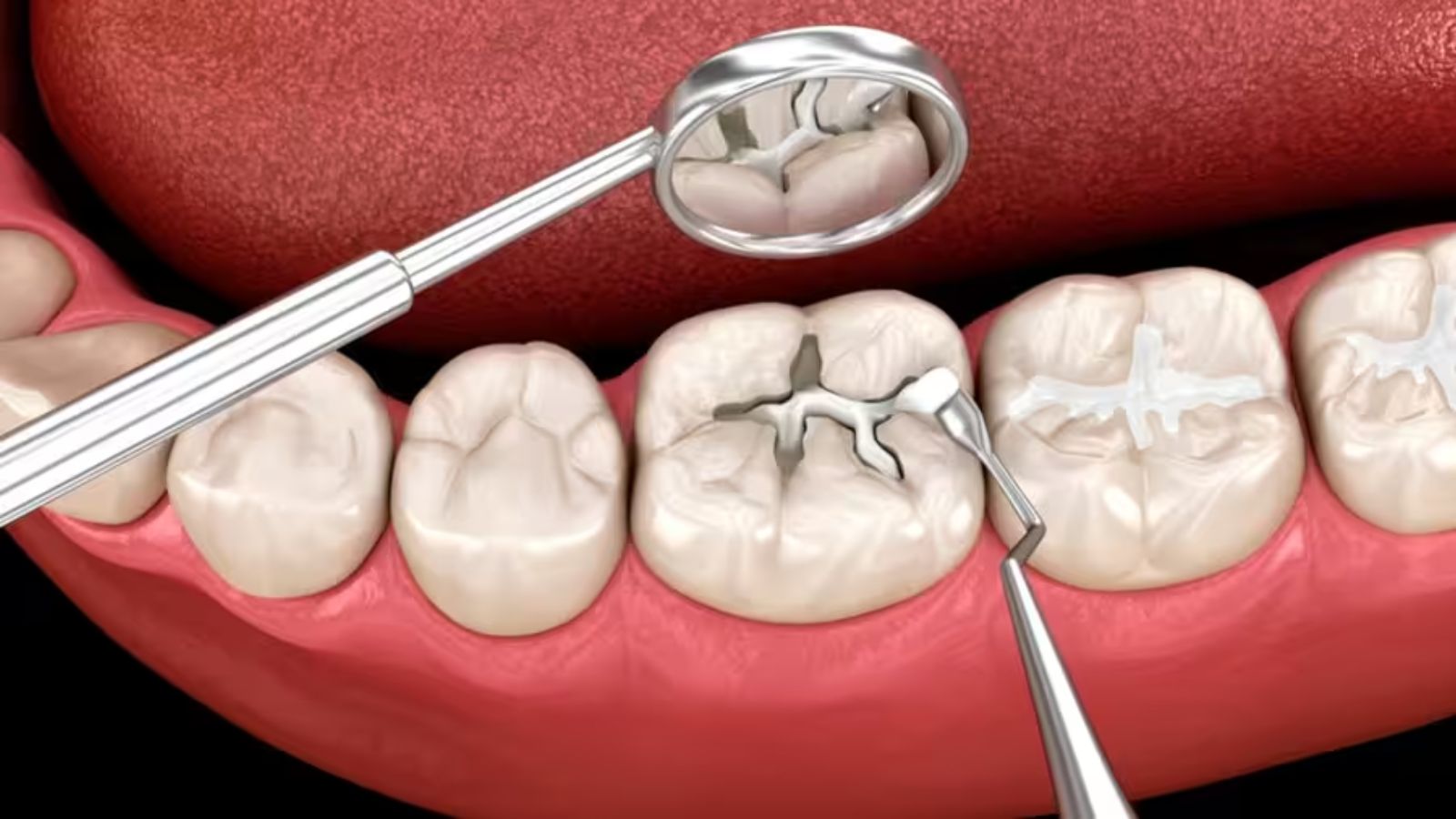 Trám răng cần được các bác sĩ tư vấn, điều trị.