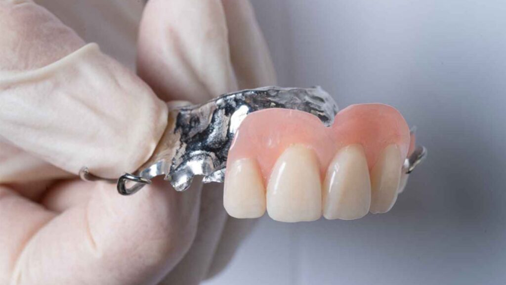 Các loại lắp răng giả tháo lắp phù hợp với từng nhu cầu